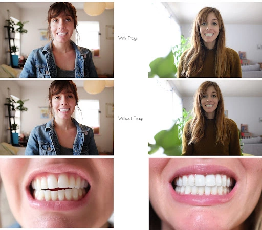Comparison of patient’s teeth with and without Invisalign trays and the before and after close up shots