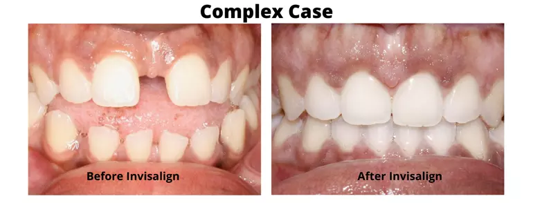 Close up of teeth with complex alignment problems before and after Invisalign treatment in San Diego and Del Mar California