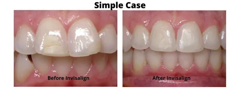 Invisalign Dentist in San Diego and Del Mar California - before and after