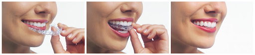 Person wearing aligners in three phases