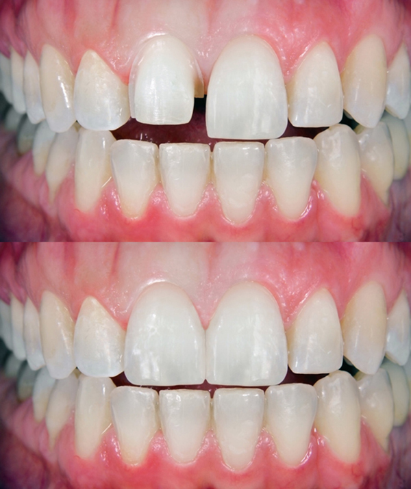 Before and after photo of a reduced tooth
