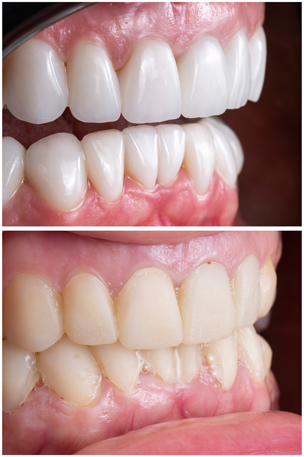 Close up of teeth with and without ceramic veneers