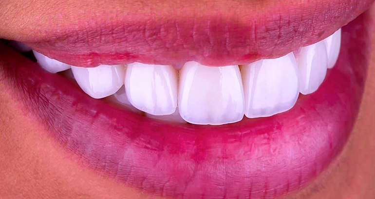 Close up of a smile with veneers