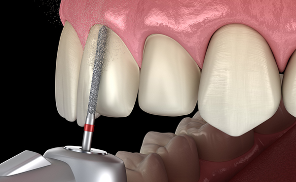Teeth Reduction Veneers