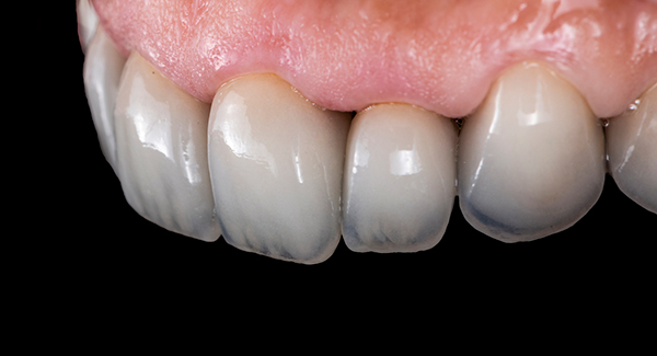 Close up of veneers with imperfections