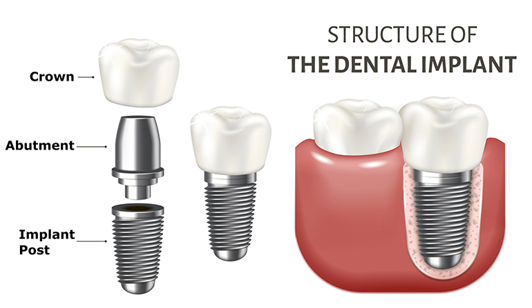 Structure of an implant showing crown, abutment, and implant post that affect total dental implant cost