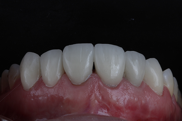 Dental crowns made with high quality material that can increase dental implant cost