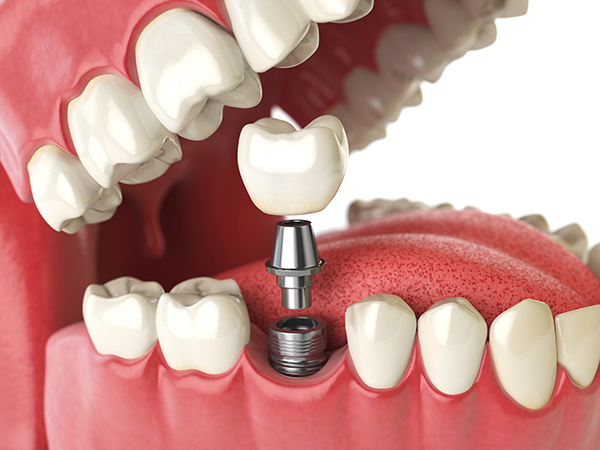 Close up of a dental implant with abutment and crown