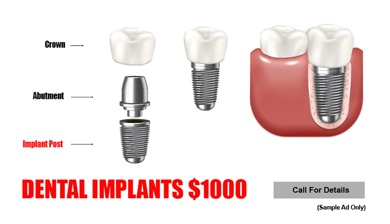 Sample misleading dental implant ad
