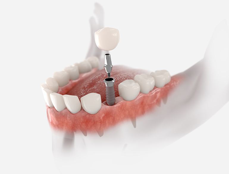 dental implant model showing crown, abutment, and post