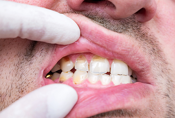 Hypoplastic teeth requiring cosmetic treatment