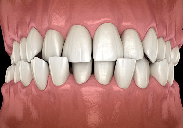 Porcelain veneers are not suitable for severely misaligned teeth
