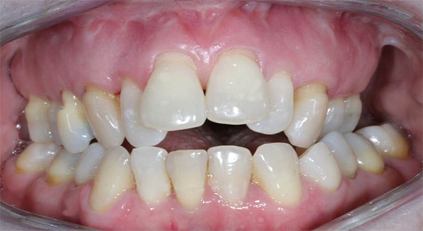 Severely crooked teeth that are not fit for Invisalign treatment