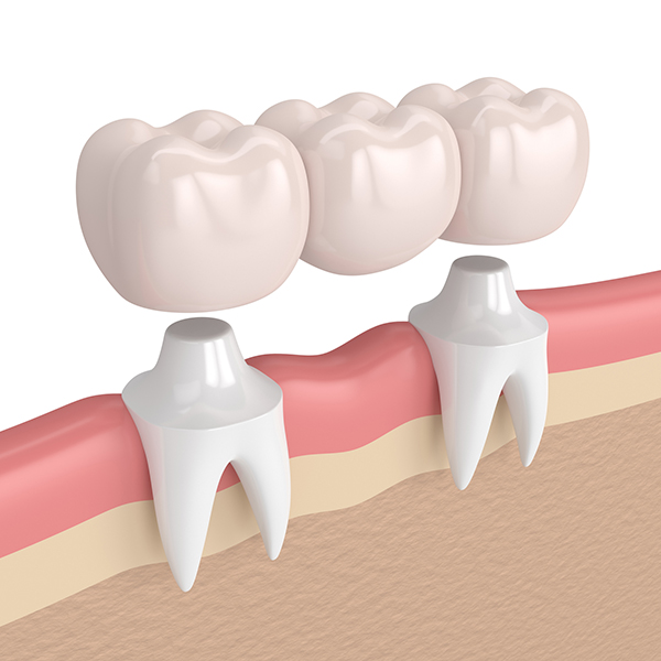 missing tooth treatment - dental bridge