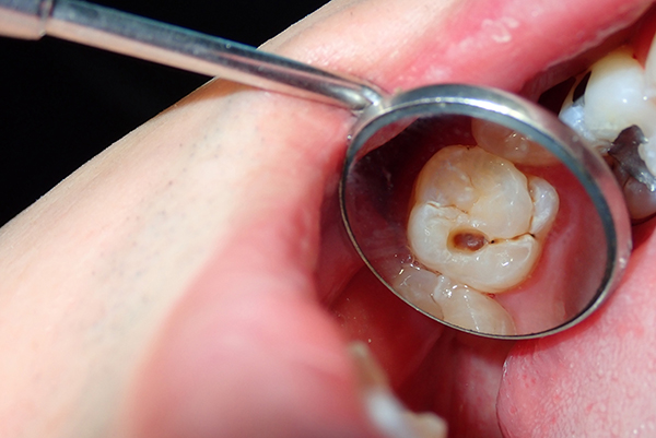 tooth cavity causes tooth loss