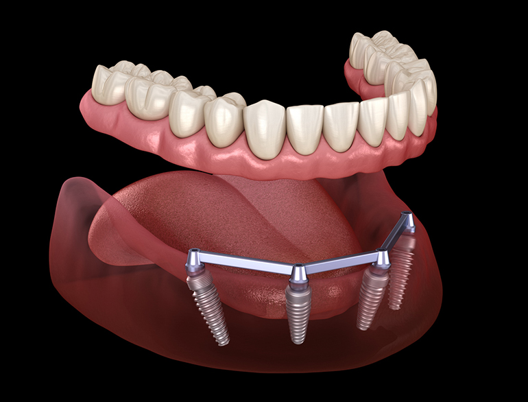 3d rendering of overdentures on top of four dental implants