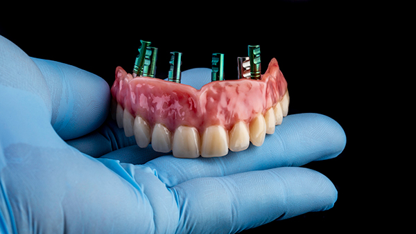 dental prosthesis or denture with metal screws to attach to dental implants