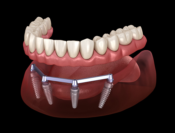 all-on-4 implants with overdenture