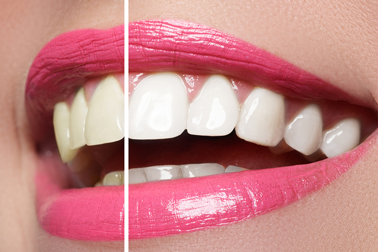 before and after teeth whitening of a woman’s smile