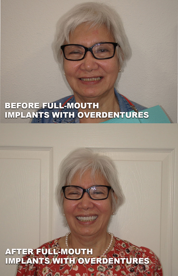 before and after image of full-mouth implants with overdentures