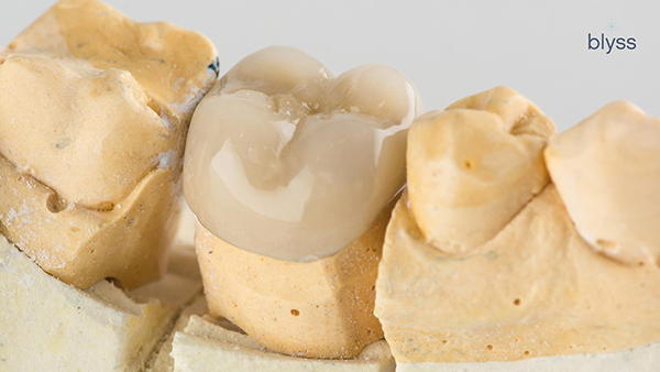 close up of all porcelain crown on dental model
