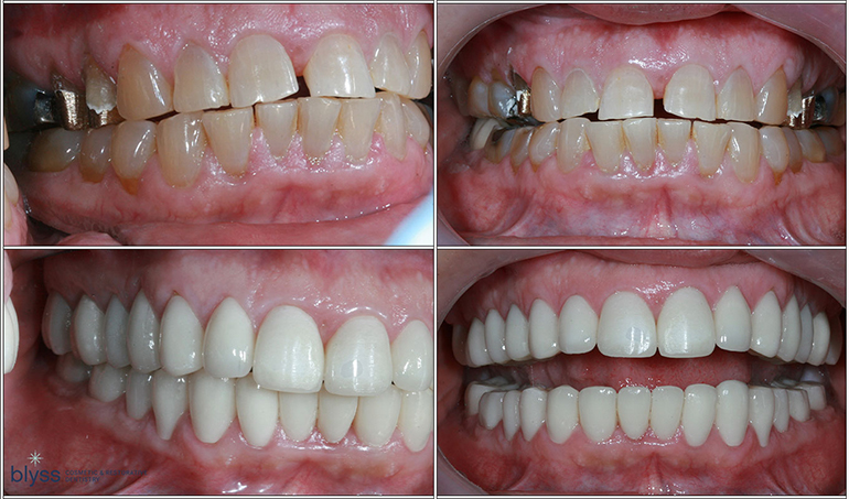 full-mouth reconstruction using dental crowns