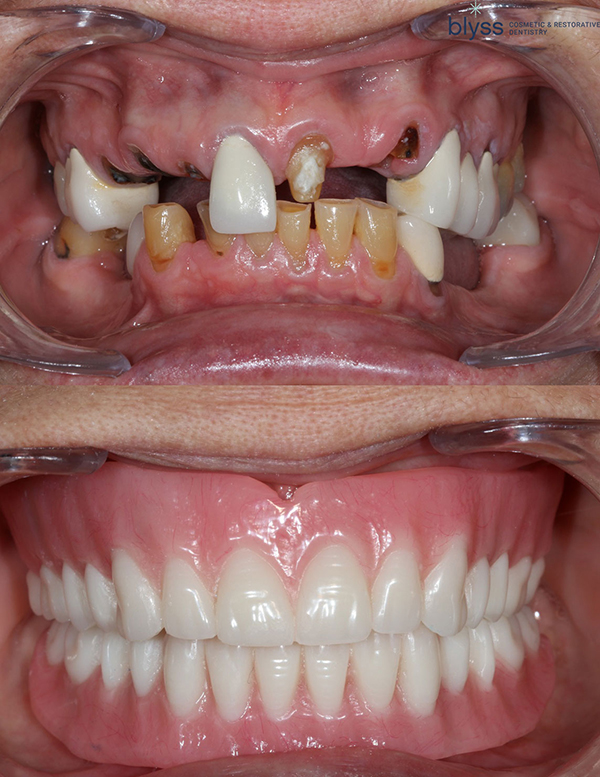 before and after - full-mouth reconstruction with dentures and implants 