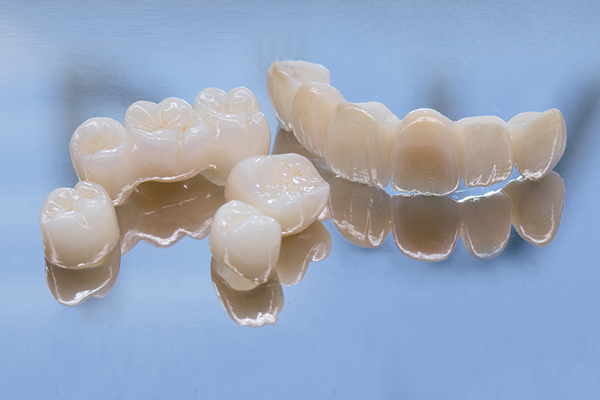 dental crowns and bridges for full-mouth restoration