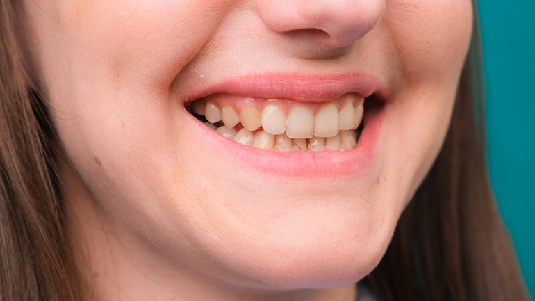 woman smiling with yellow teeth