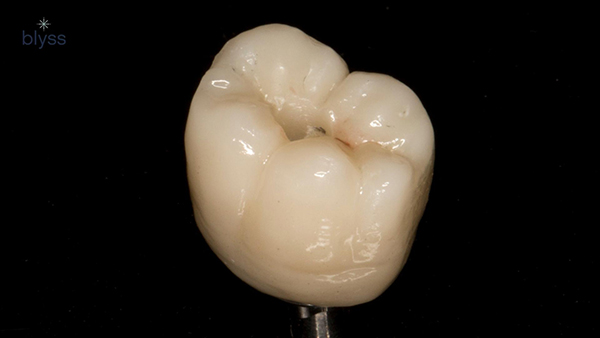 close up of a zirconia crown