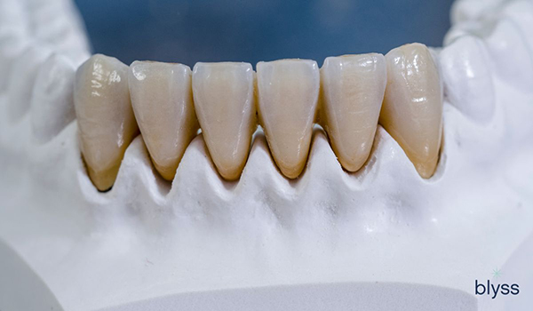 close up of monolithic zirconia teeth