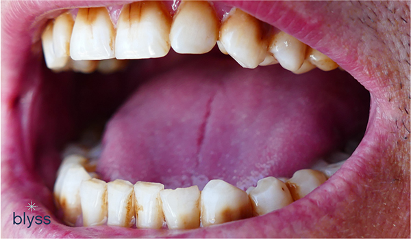 close-up of badly stained teeth