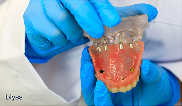 model of dental implants and full-mouth dentures