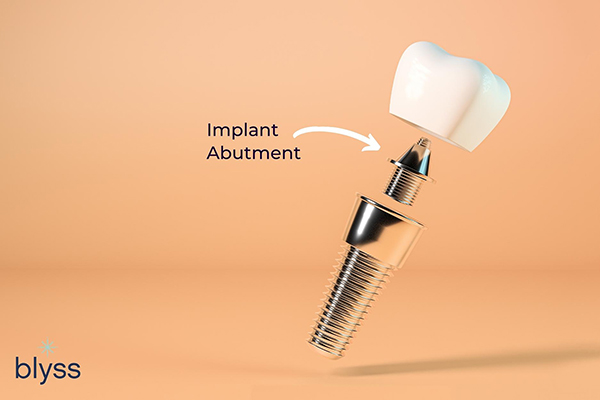 3D rendering of a dental implant post, abutment, and dental crown