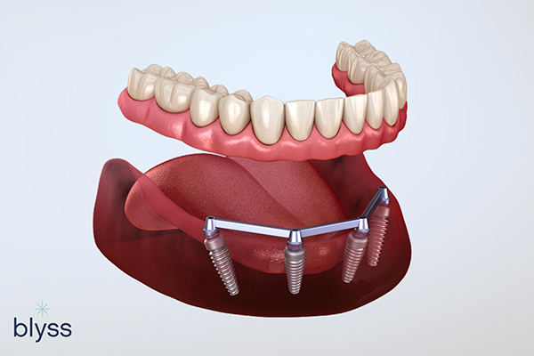 3D rendering of All-on-4 dental implants