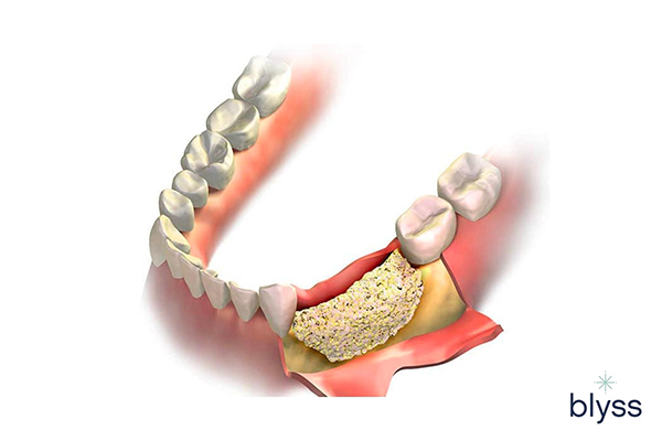 3D illustration of dental bone grafting procedure in the lower teeth