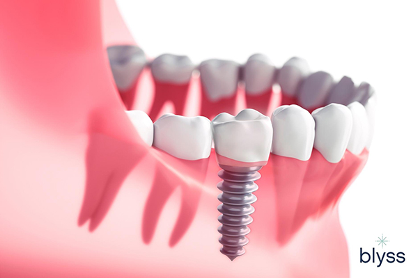 close-up of an artificial dental implant in the lower teeth