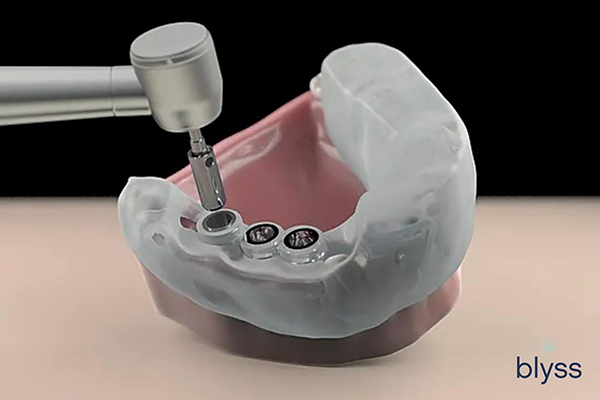 surgical guides for dental implants