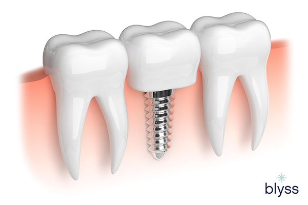 3D model of teeth and dental implant