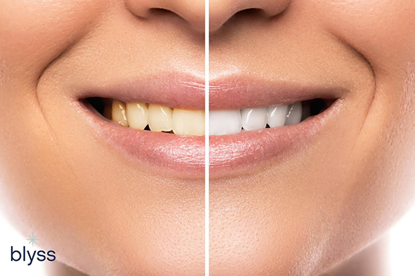 close-up of female mouth comparing before and after teeth whitening