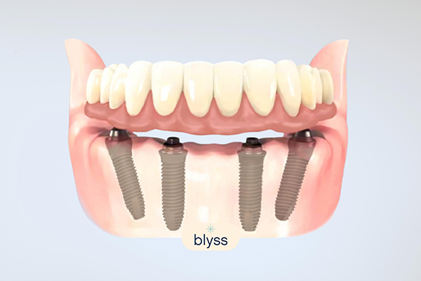 3D illustration of All-on-4 dental implants for lower jaw