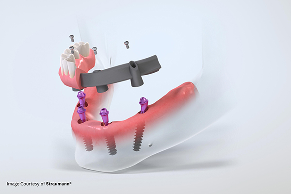 3D illustration of all-on-4 dental implant