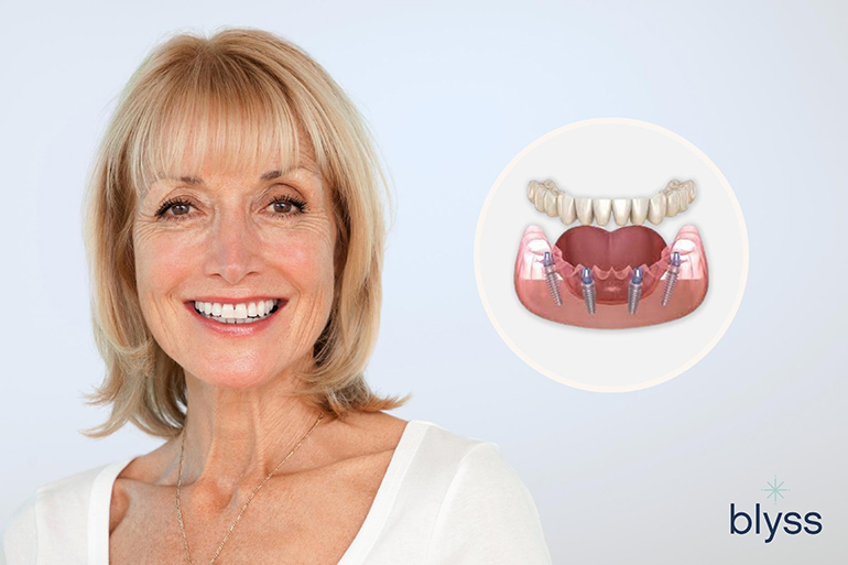 adult woman living in San Diego smiling with a digital 3D illustration of all-on-4 dental implants