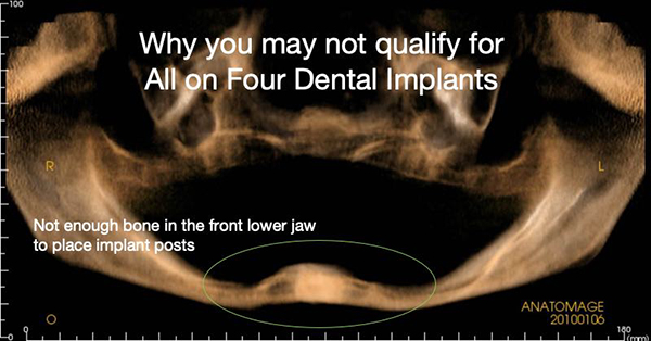 X-ray scan result of jawbone showing patient disqualification for All-on-4 procedure