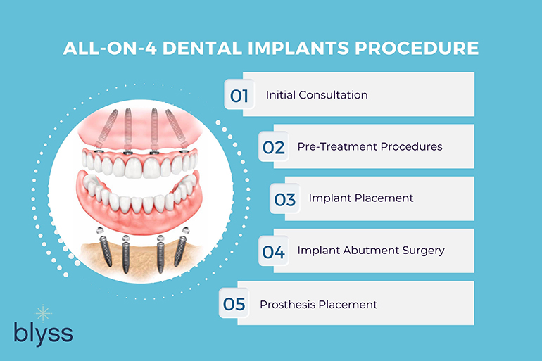 all-on-4 dental implants procedure infographic by blyss dental
