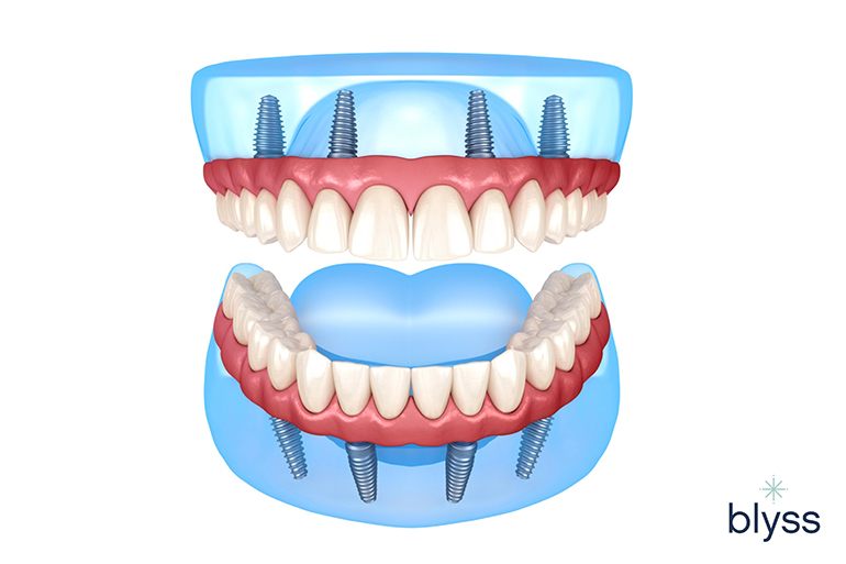 3D model of a full mouth All-on-4 dental implant