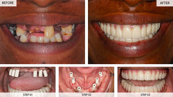 before and after images of all-on-6 dental implants recipient
