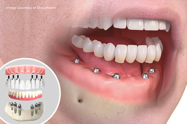 3D illustration of all-on-6 dental implants on patient mouth