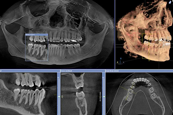 CT scan results of patient jawbone