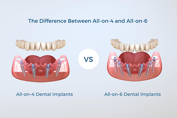 3D illustration of all-on-4 and all-on-6 dental implants